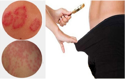 Ngứa tinh hoàn là biểu hiện của bệnh nấm tinh hoàn
